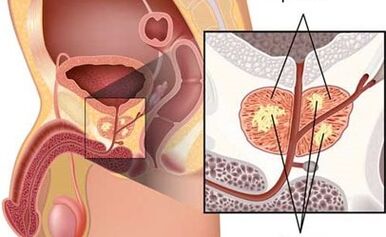 prostate