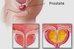 prostate