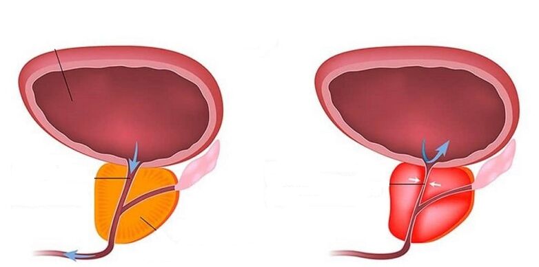 Tendurist û prîman bi prostatitis