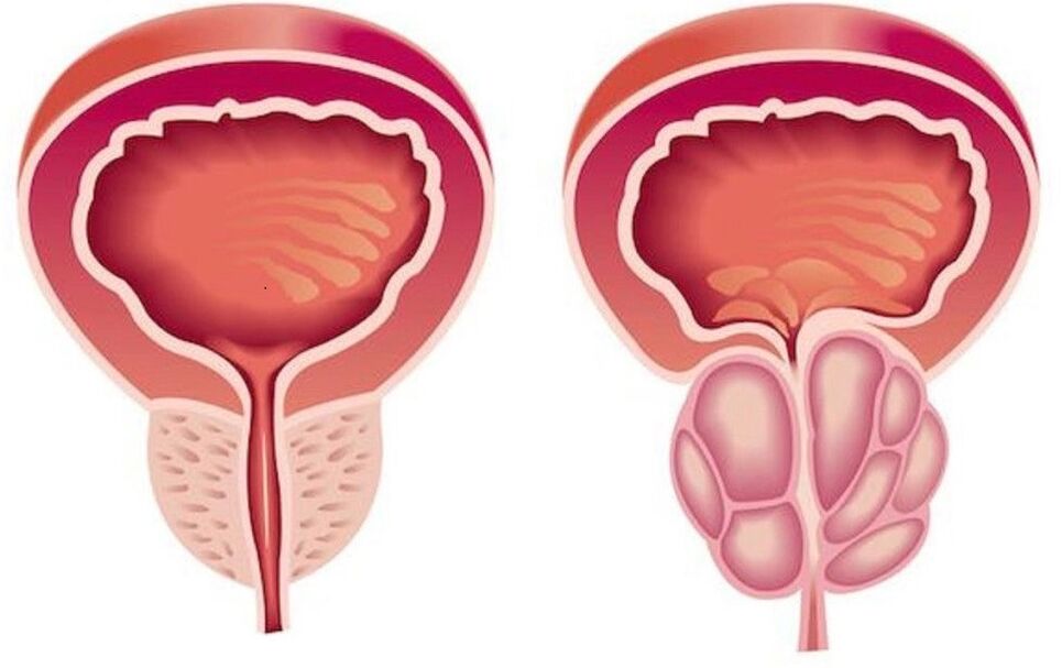 prostatê saxlem û iltîhaba bi prostatitis
